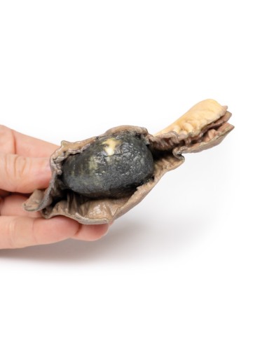 Iléo avec calculs - Erler Zimmer 3D anatomy...