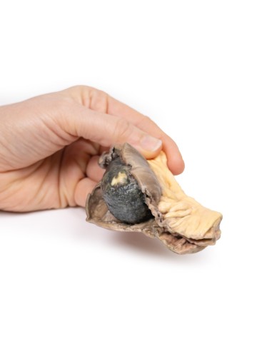 Ileo con calcoli  - Erler Zimmer 3D anatomy...
