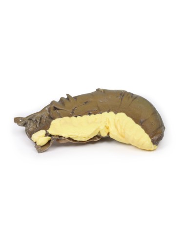 Intususcepción del intestino delgado por tumor...