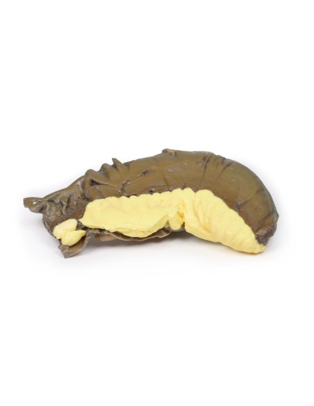 Intussusception de l'intestin grêle due à une tumeur métastatique - Erler Zimmer 3D anatomy Series MP2077