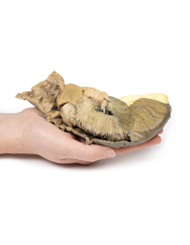 Intussusception of the small intestine by...