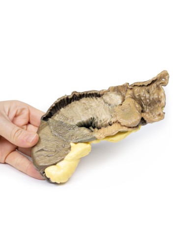 Intususcepción del intestino delgado por tumor...