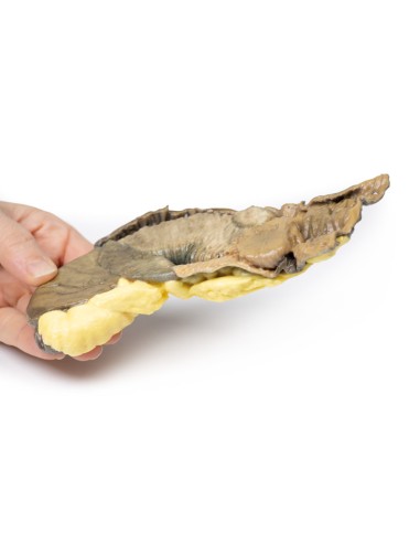 Intussusception of the small intestine by...