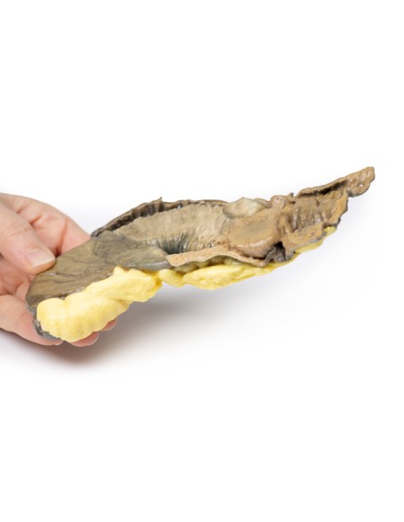 Intussusception of the small intestine by metastatic tumor - Erler Zimmer 3D anatomy Series MP2077