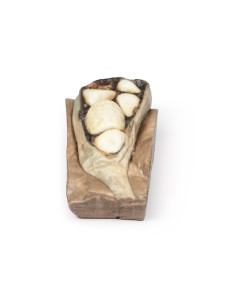 Cholelithiasis (gallstones)- Erler Zimmer 3D anatomy...