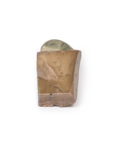 Cholelithiasis (gallstones)- Erler Zimmer 3D anatomy... 2