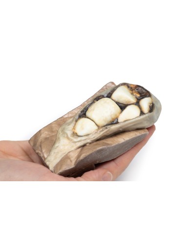 Cholelithiasis (gallstones)- Erler Zimmer 3D...