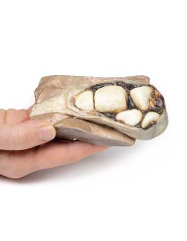 Colelitiasi (calcoli biliari)- Erler Zimmer 3D...