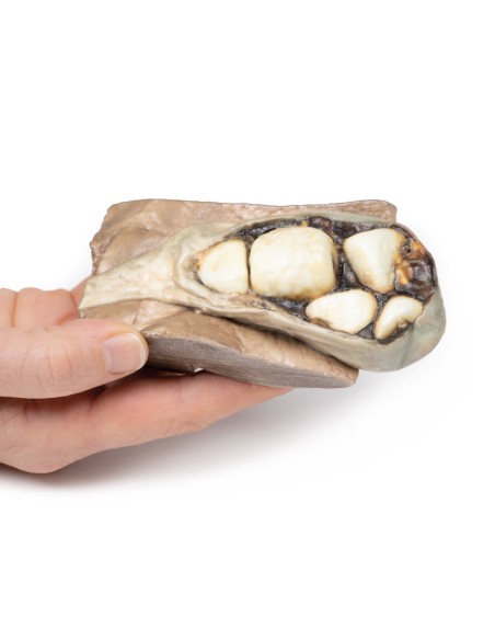 Colelitiasi (calcoli biliari)- Erler Zimmer 3D anatomy Series MP2075