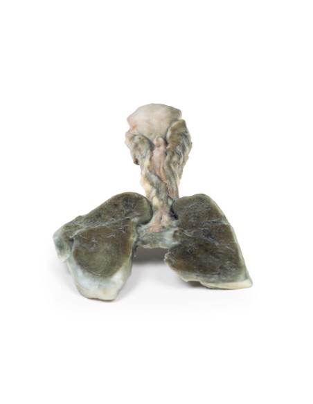 Tracheoesophageal fistula and esophageal atresia - Erler Zimmer 3D anatomy Series MP2059