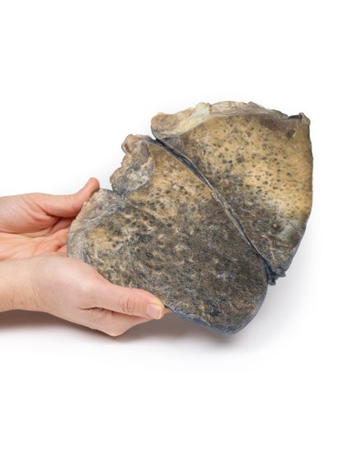 Bronchopneumonie - Erler Zimmer 3D Anatomie...