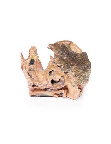 Inhaled foreign body: trachea - Erler Zimmer 3D...