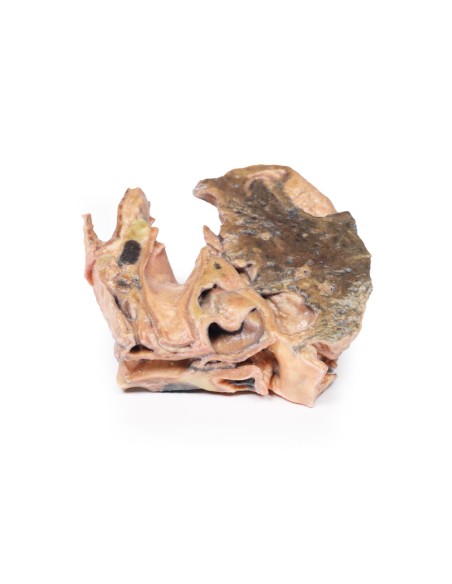 Corpo estraneo inalato: trachea - Erler Zimmer 3D anatomy Series MP2053