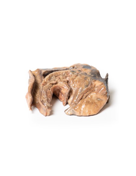 Corpo estraneo inalato: trachea - Erler Zimmer 3D anatomy Series MP2053