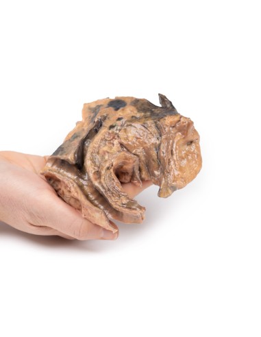 Inhaled foreign body: trachea - Erler Zimmer 3D...