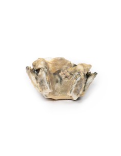 Carcinoma of the larynx - Erler Zimmer 3D anatomy Series...