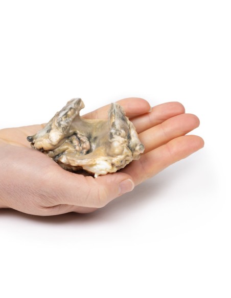 Carcinoma of the larynx - Erler Zimmer 3D anatomy Series MP2052