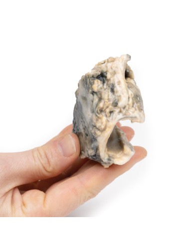 Carcinoma de laringe - Erler Zimmer 3D anatomy...