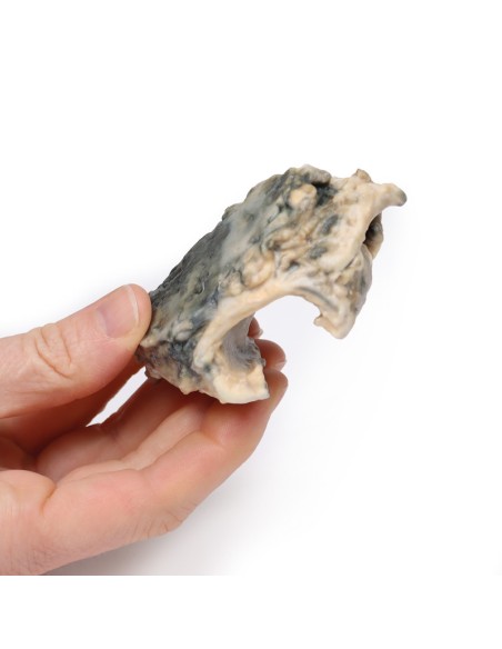 Carcinoma de laringe - Erler Zimmer 3D anatomy Series MP2052