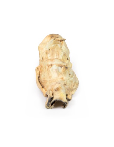 Carcinoma of the larynx - Erler Zimmer 3D...