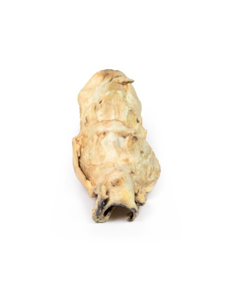 Carcinoma de laringe - Erler Zimmer 3D anatomy Series MP2050