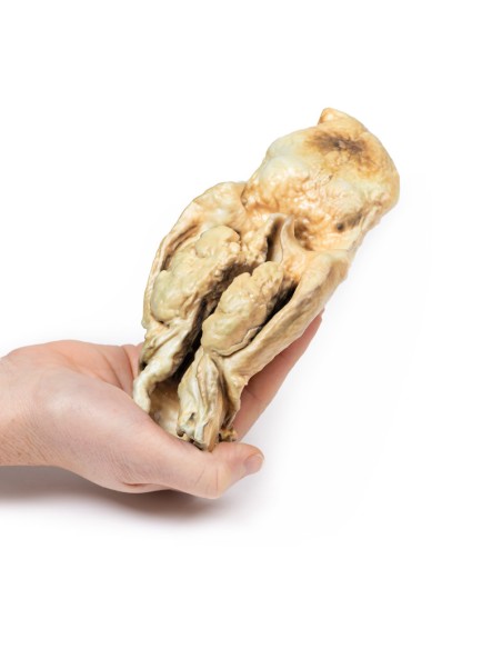 Carcinoma della laringe - Erler Zimmer 3D anatomy Series MP2050