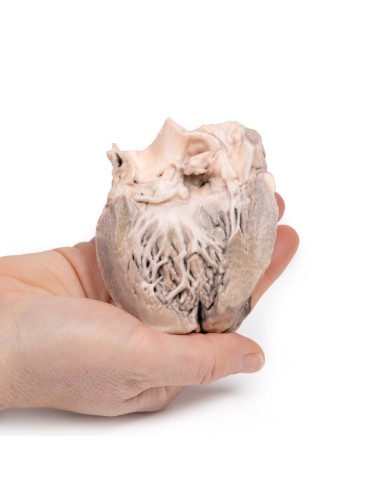 Endocarditis bacteriana aguda - Erler Zimmer 3D...