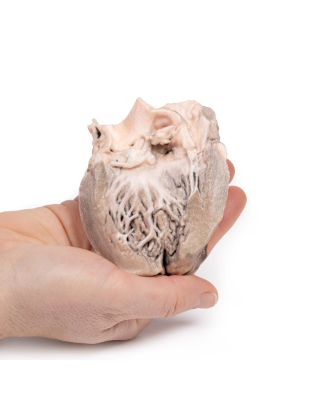 Akute bakterielle Endokarditis - Erler Zimmer 3D Anatomie Serie MP2041