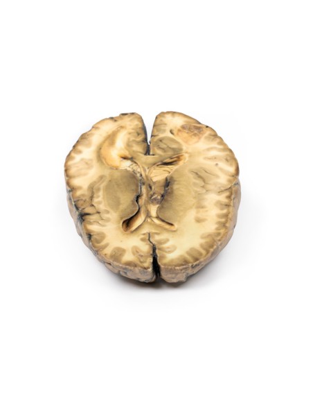 Carcinoma metastásico en el cerebro - Erler Zimmer 3D anatomy Series MP2019