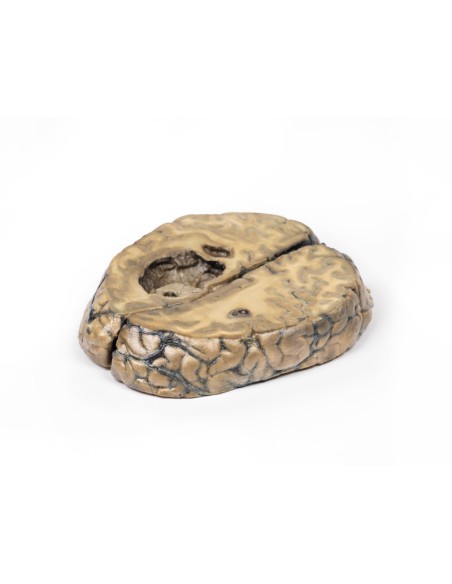 Carcinoma metastatico nel cervello - Erler Zimmer 3D anatomy Series MP2019