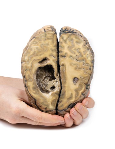 Carcinome métastatique dans le cerveau - Erler...