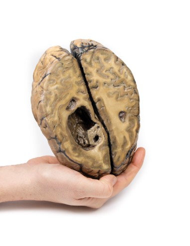 Metastatic carcinoma in the brain - Erler...