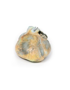 Right ventricular hypertrophy - Erler Zimmer 3D anatomy...