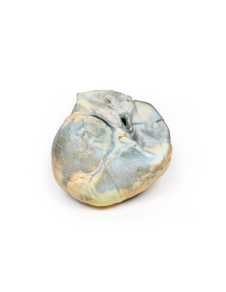 Hipertrofia ventricular derecha - Erler Zimmer 3D anatomy Series MP2031