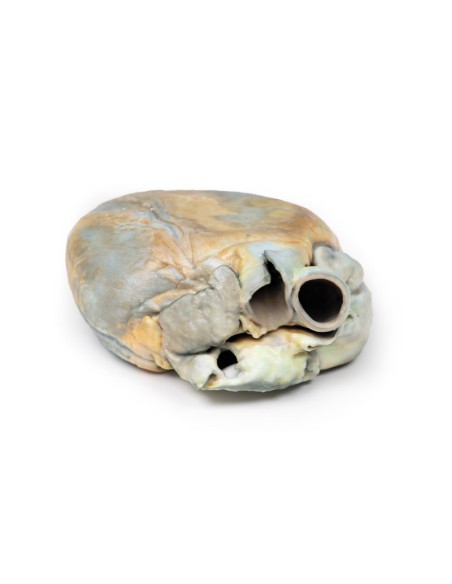 Hypertrophie ventriculaire droite - Erler Zimmer 3D anatomy Series MP2031