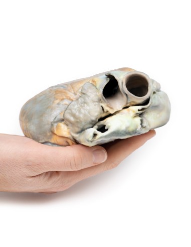 Hipertrofia ventricular derecha - Erler Zimmer...