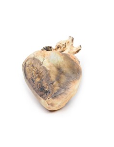 Interatrial Defect - Erler Zimmer 3D anatomy Series MP2032