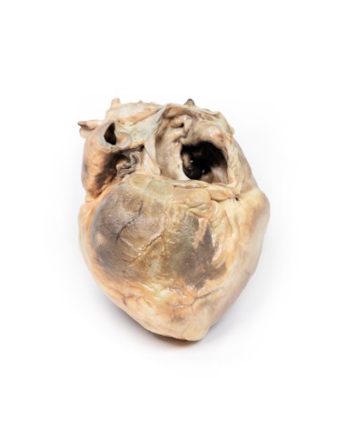 Défaut interatrial - Erler Zimmer 3D anatomy...