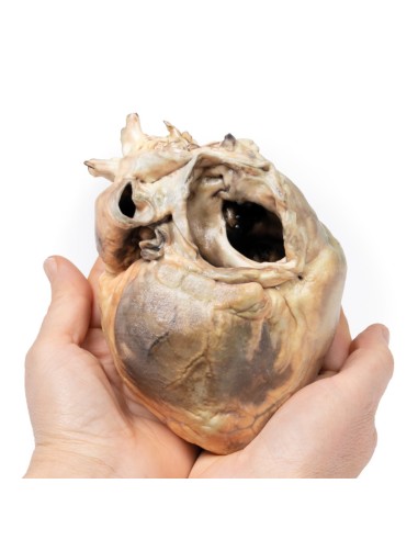 Interatrial Defect - Erler Zimmer 3D anatomy...