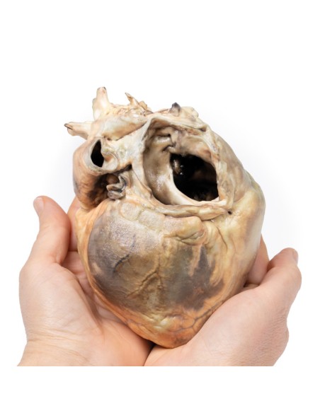 Defecto interauricular - Erler Zimmer 3D anatomy Series MP2032