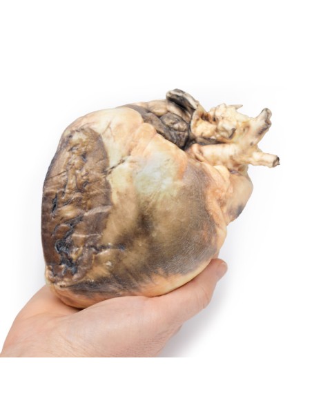 Interatrial Defect - Erler Zimmer 3D anatomy Series MP2032