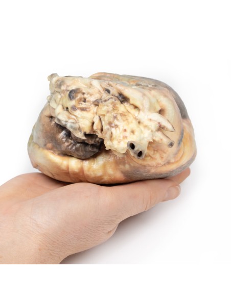 Interatrialer Defekt - Erler Zimmer 3D Anatomie Serie MP2032