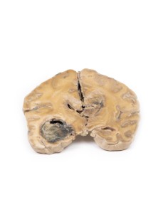 Glioblastoma multiforme - Erler Zimmer 3D anatomy Series...