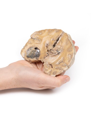 Glioblastoma multiforme - Erler Zimmer...