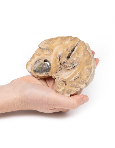 Glioblastoma multiforme - Erler Zimmer 3D anatomy Series MP2015