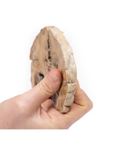 Glioblastoma multiforme - Erler Zimmer...