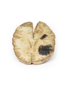 Cerebral hemorrhage, secondary to acute myeloid leukemia... 2