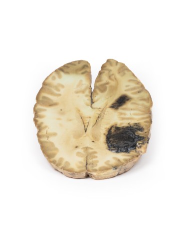 Hemorragia cerebral secundaria a leucemia...