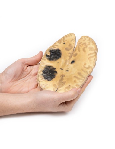 Emorragia cerebrale, secondaria a leucemia...