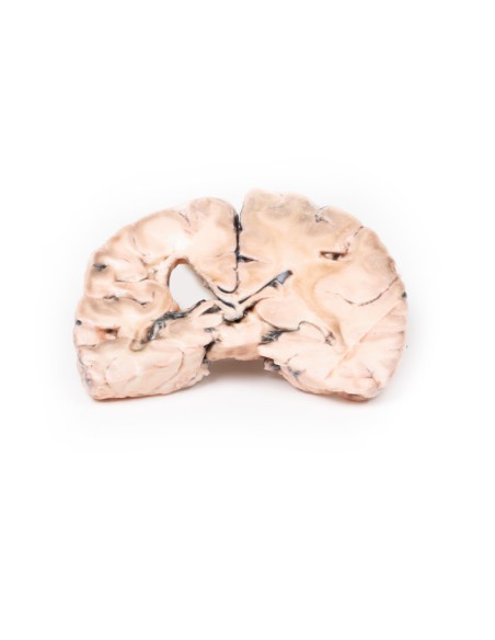 Infarto cerebral izquierdo - Erler Zimmer 3D anatomy Series MP2005